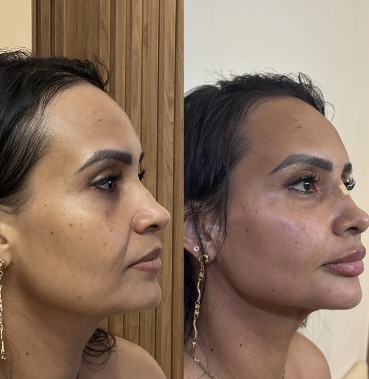 Antes e depois de harmonização facial com perfil refinado e rejuvenescimento natural
