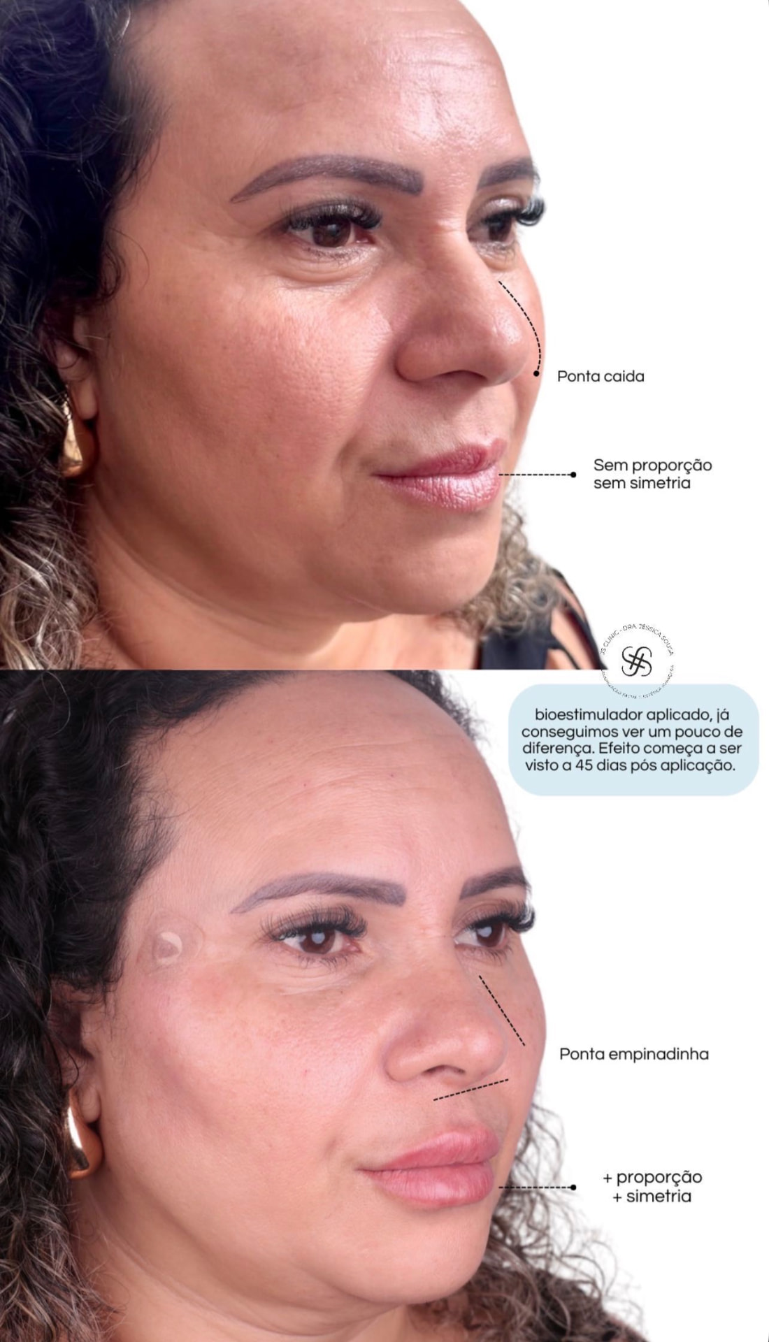 Bioestimulador de Colágeno — Dra. Jéssica Sousa