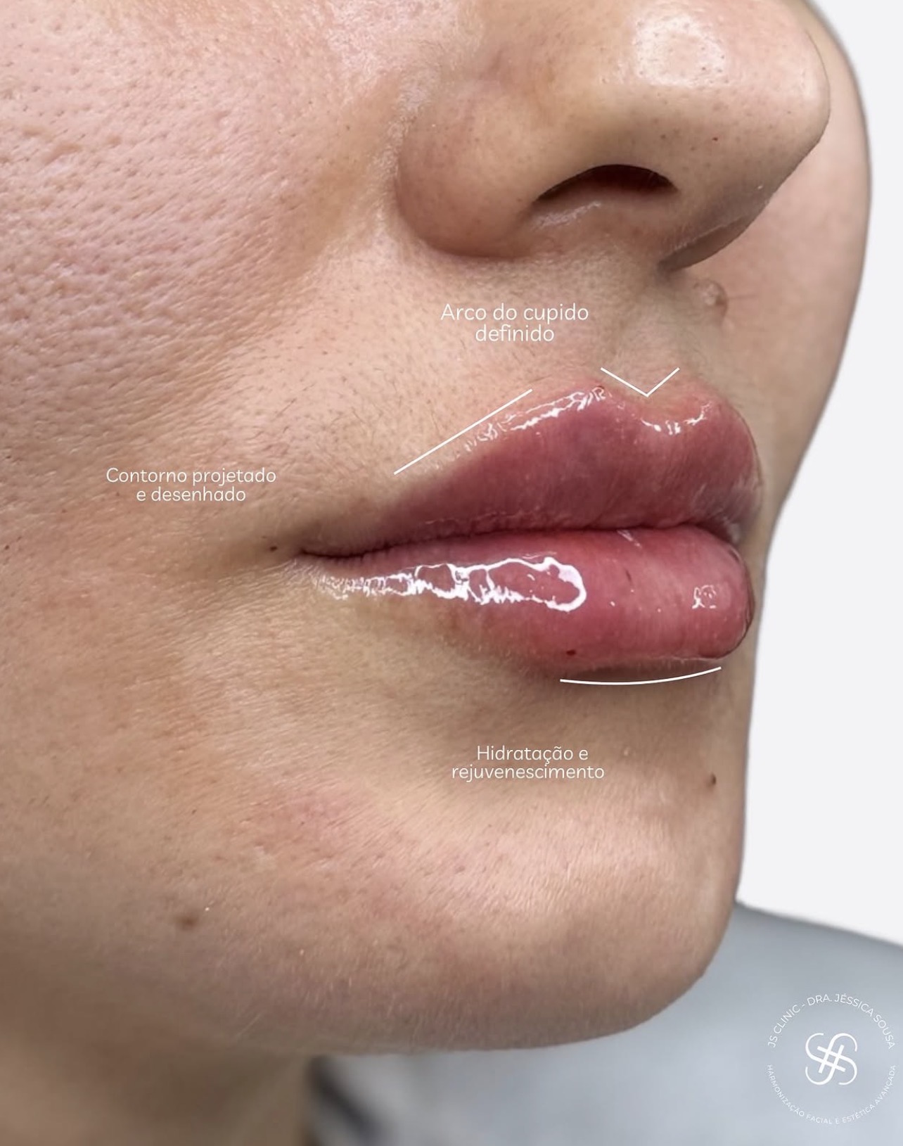Contorno labial desenhado com hidratação e rejuvenescimento
