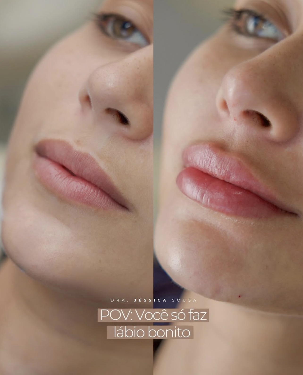 Antes e depois de preenchimento labial com resultado natural