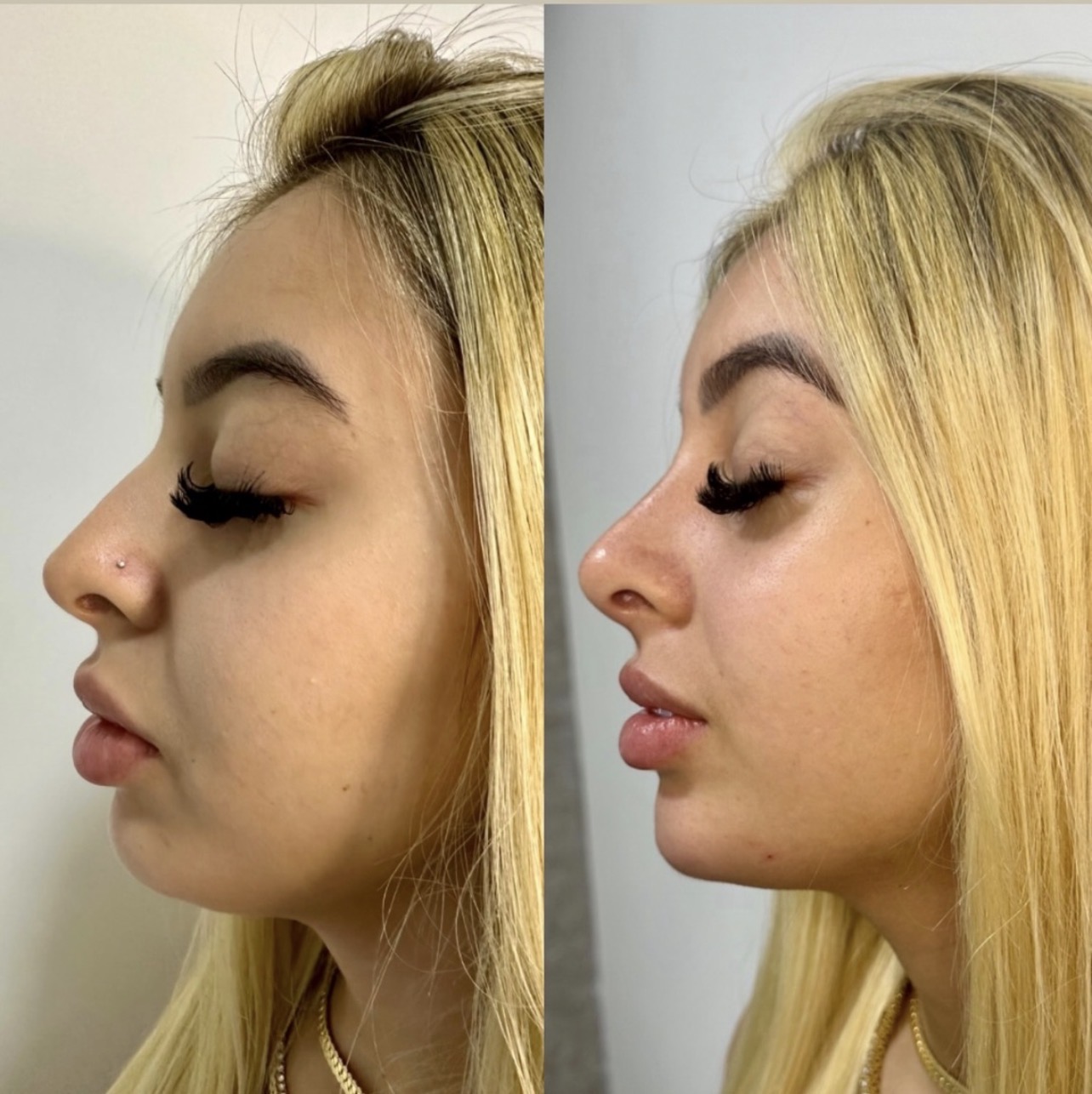 Resultado de rinomodelação sem cirurgia pela Dra. Jéssica Sousa