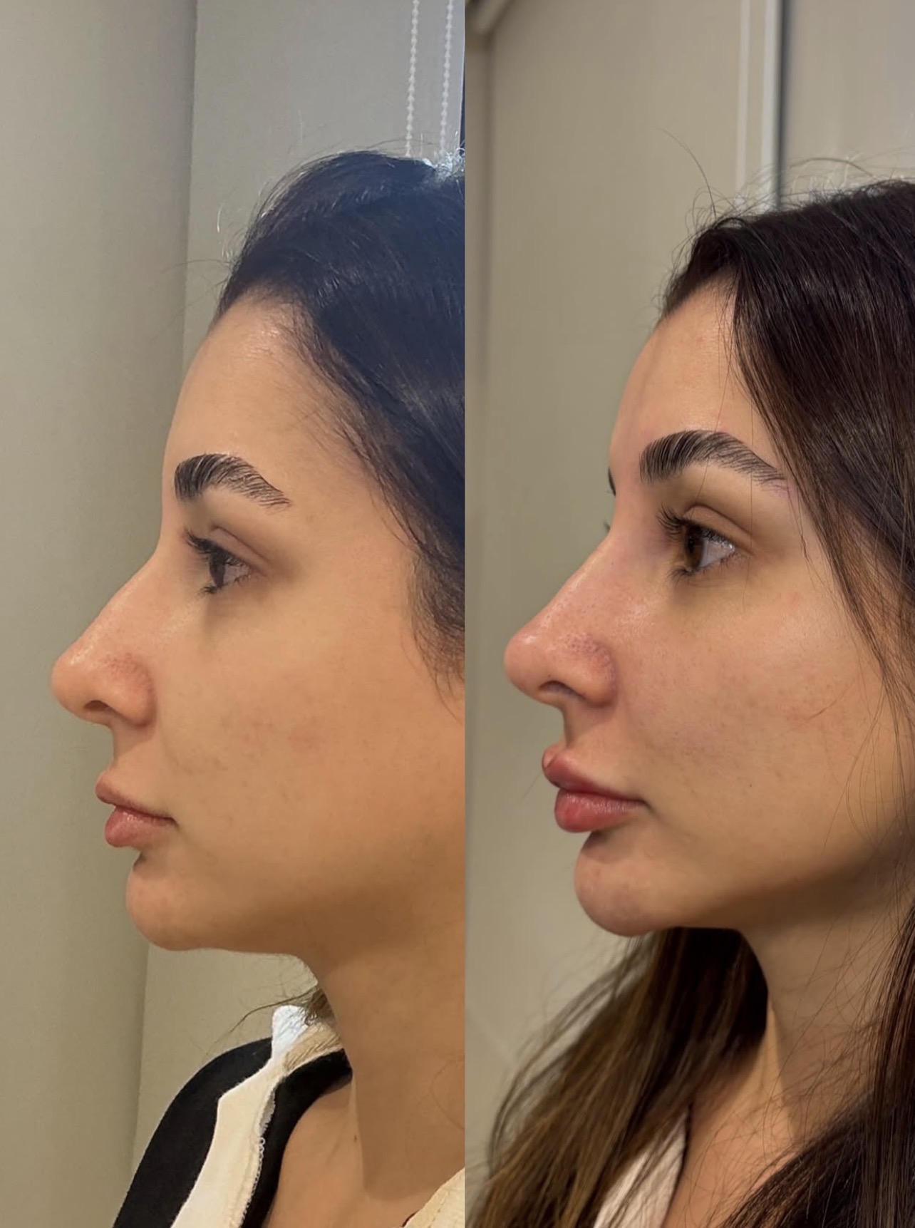 Antes e depois de perfil com projeção labial equilibrada