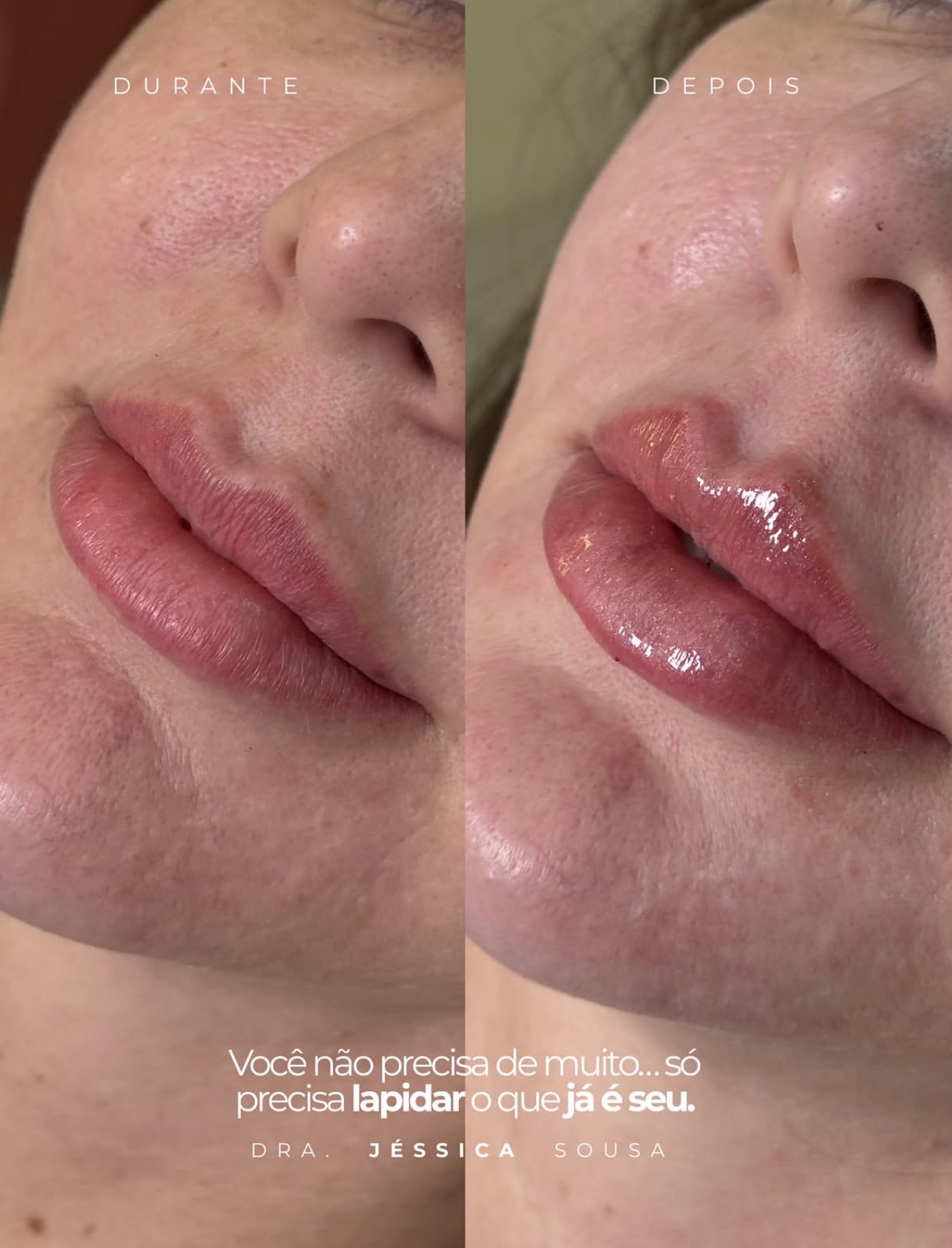 Durante e depois de preenchimento labial com contorno definido
