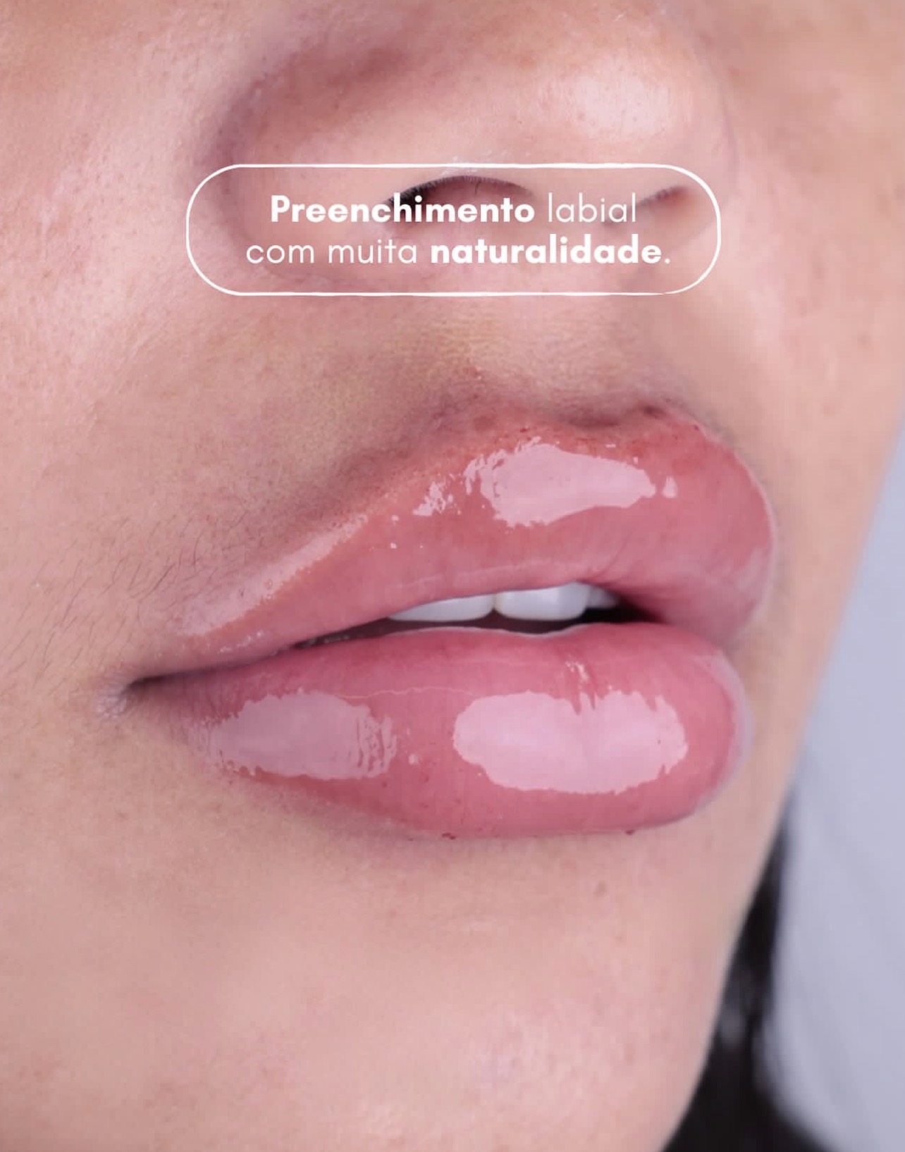 Preenchimento labial com muita naturalidade