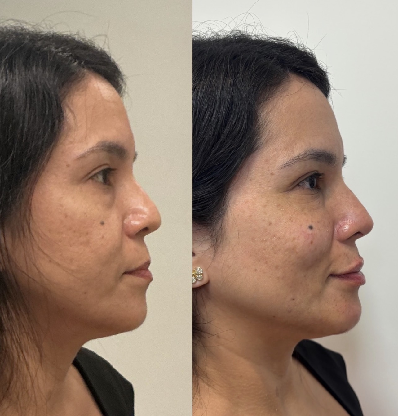 Antes e depois de perfil com rinomodelação e projeção de mento
