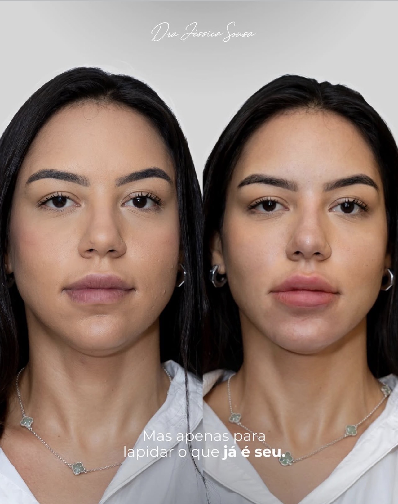 Antes e depois de harmonização facial de frente com a Dra. Jéssica Sousa