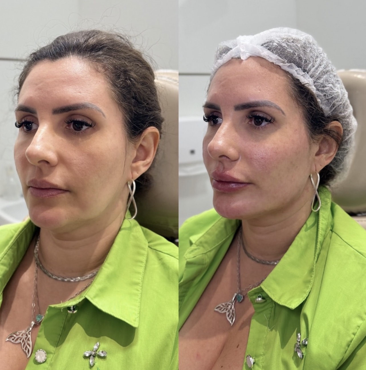 Antes e depois de full face com contorno facial definido e natural