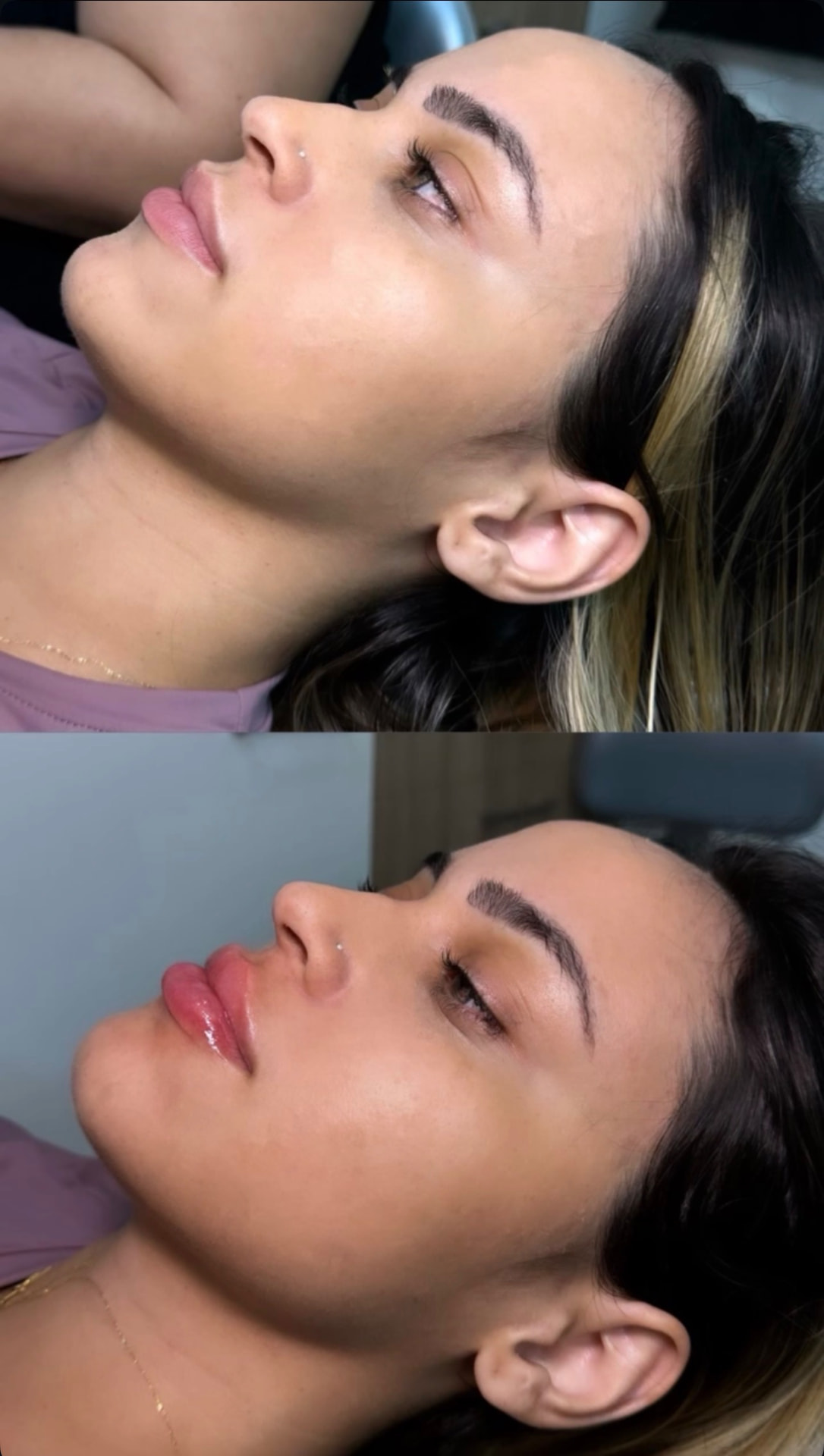 Resultado de preenchimento labial natural pela Dra. Jéssica Sousa