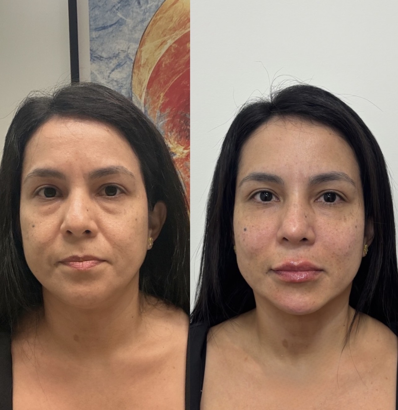 Antes e depois de full face de frente com contorno facial definido