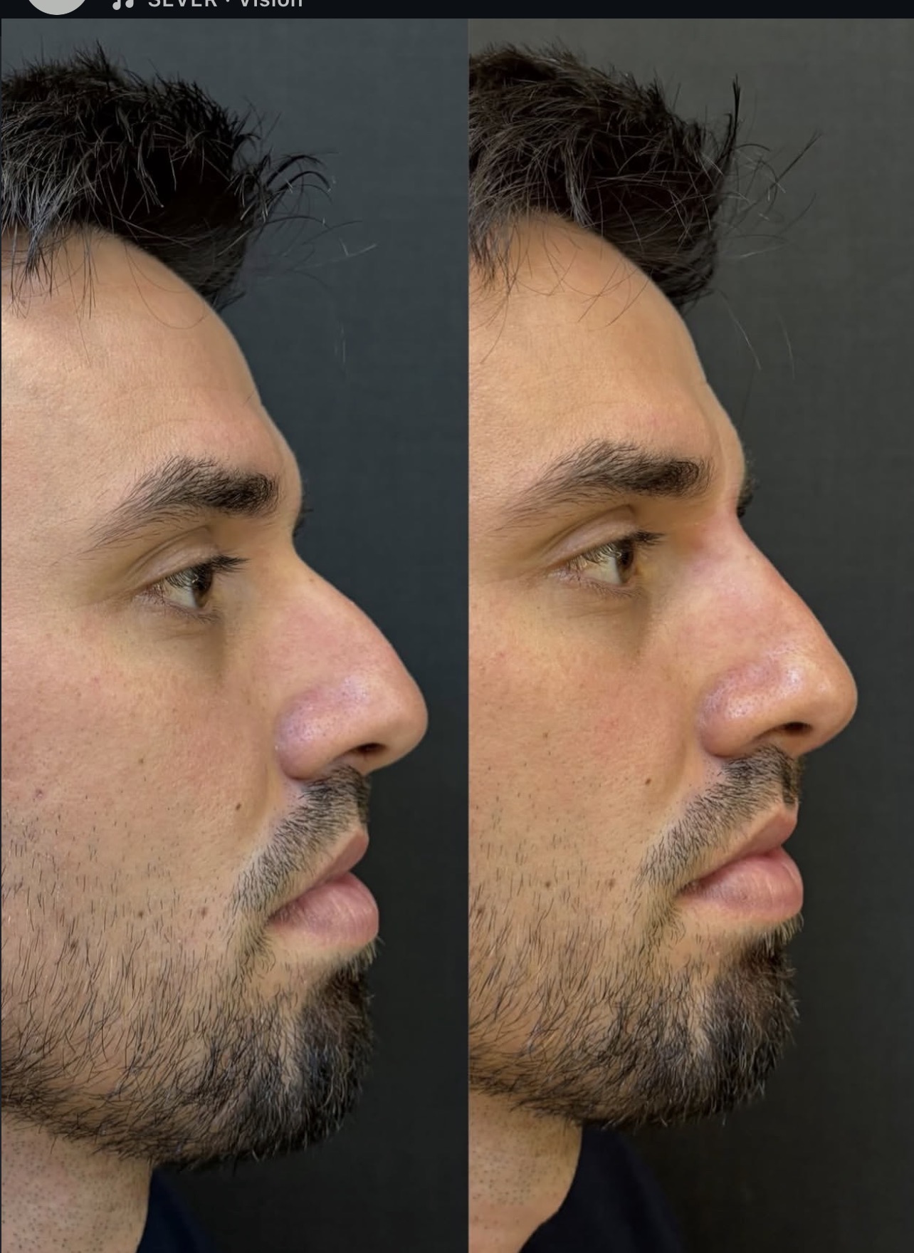 Antes e depois de rinomodelação masculina com perfil harmonizado