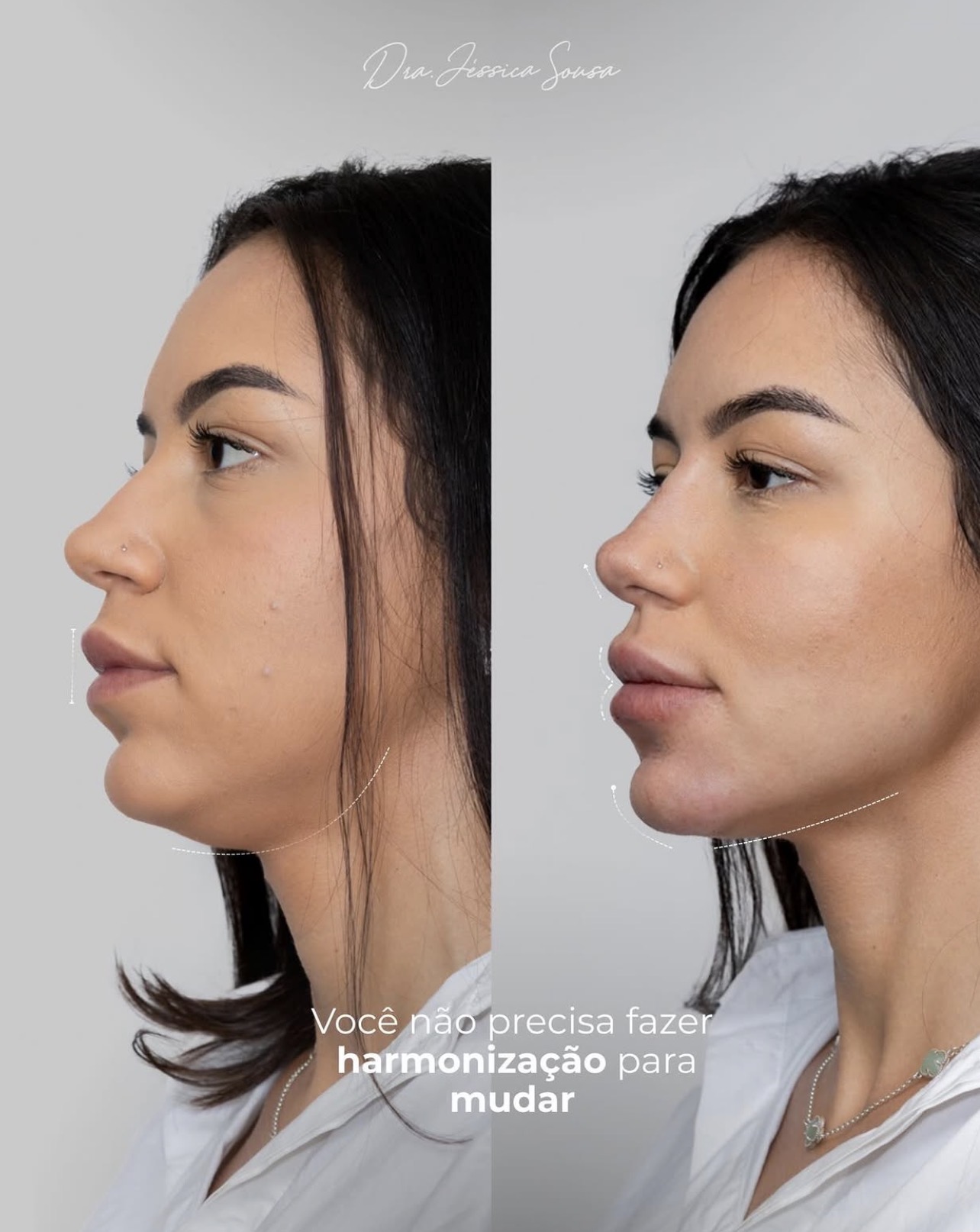 Antes e depois de perfil com contorno mandibular harmonizado
